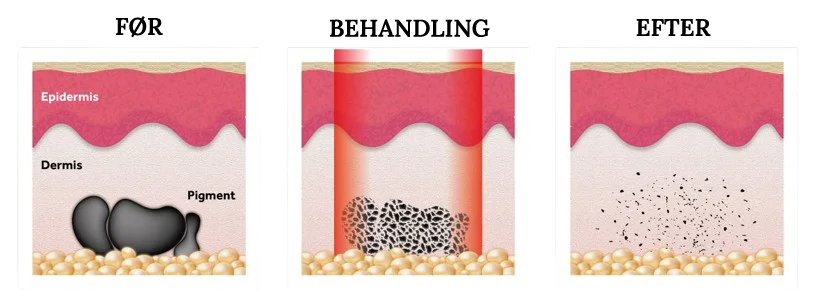 tattooremoval